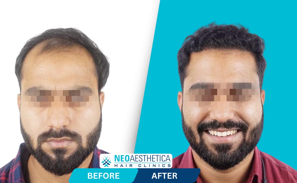 Hair transplant Results Lucknow | Hair Transplant Before and After | Neoaesthetica
