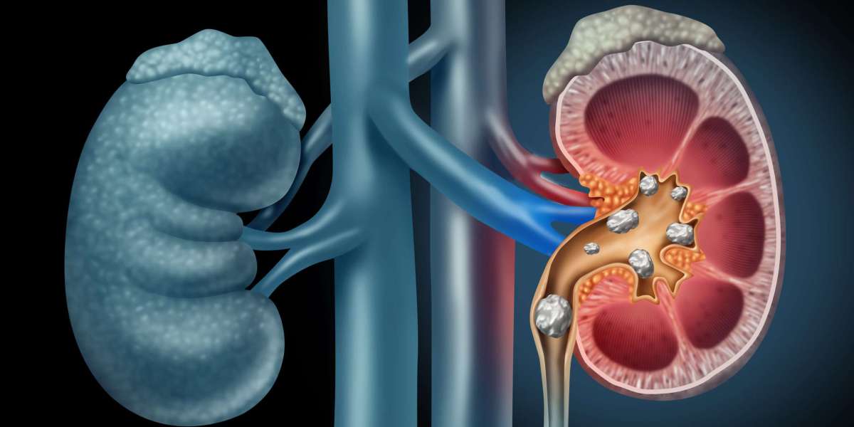 Kidney Cancer Market Analysis, Opportunities, Growth
