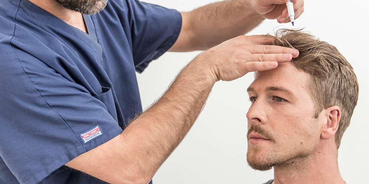 Exploring the Average Hair Transplant Cost: What to Expect