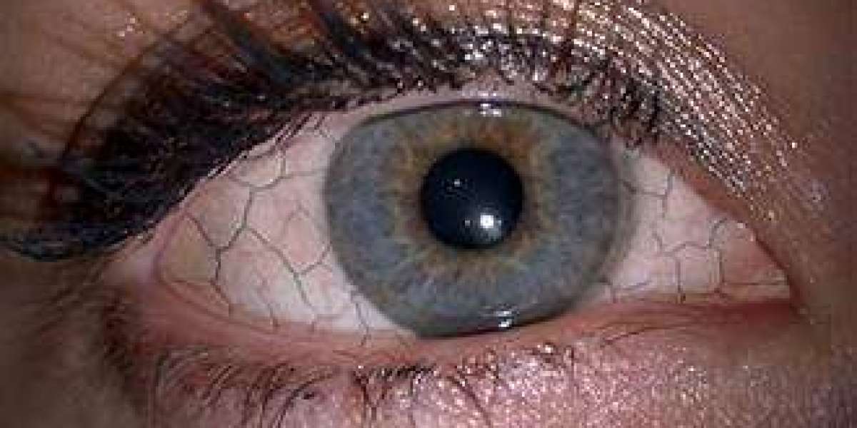 Locating Pain relief: Researching Useful Treatments intended for Dry Eye Problem