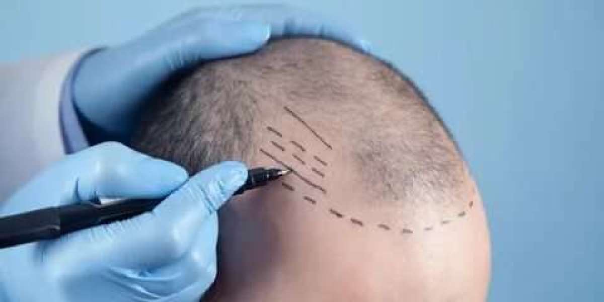 Hair Transplant: A Booming Industry in Dubai