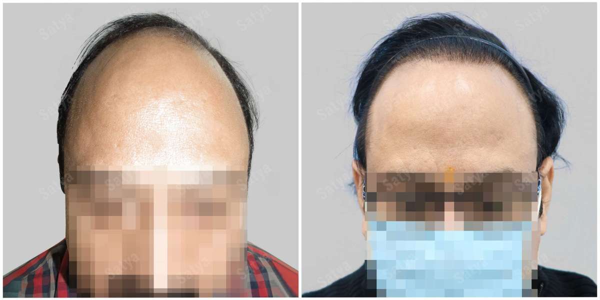 Discover the Premier Hair Transplant Clinic in Delhi NCR